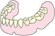 総入れ歯 （総義歯）
