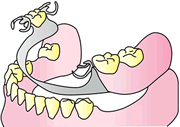 部分入れ歯 （部分義歯）